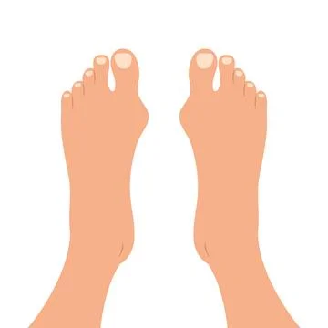 Human feet with deformities of big toe joint. Top view of bare feet Stock Illustration