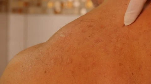 Human finger shows effects of acne on the shoulder Stock Footage 101300391