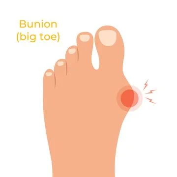 Human foot with deformities of big toe joint. Bare foot with Hallux valgus Stock Illustration