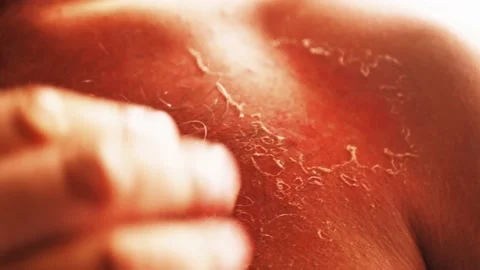 A human hand peeling his dry skin damaged after sunburn close up, skin burned 스톡 동영상 134639251