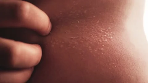 A human hand peeling his dry skin damaged after sunburn close up, skin burned Stock Footage 143087270