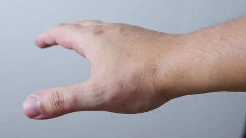 Human hand with red itchy bumps and hives from an allergic skin reaction, Stock Footage 318868641