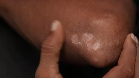Human hands scratch acute psoriasis on the elbows, Stock Footage 240244877