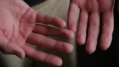 Human hands showing wrinkled pruney fingers skin after a long bath Stock Footage 337830438