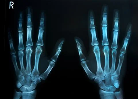 Human hands x ray Stock Photos