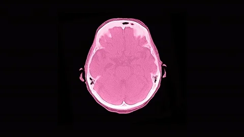 Human Head and Brain CAT Scan Stock Footage 98272778