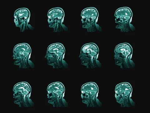 Human head and brain computer tomography image set. Vertical partition of med 스톡 사진