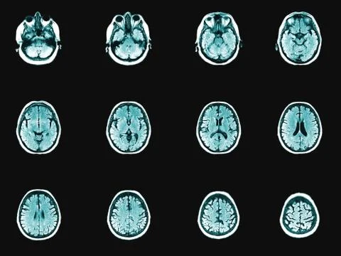 Human head and brain computer tomography image set. Horizontal partition of m 스톡 사진
