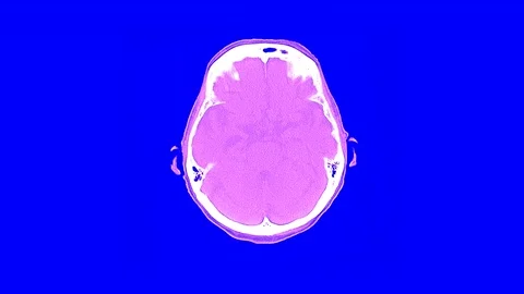 Human Head and Brain CT Scan Stock Footage 78987627