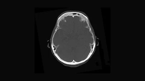 Human Head and Brain CT Scan Stock Footage 82805841