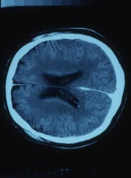 Human head with brain in x-ray image Foto stock