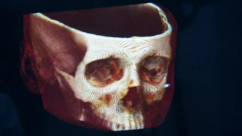Human head on CAT scans. cutaway human skull.. brain.  monitor screen Video stock 113694540