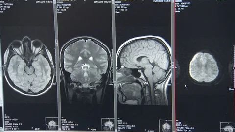 Human head on CAT scans. cutaway human skull.. brain.  monitor screen Vídeos de archivo 113694772