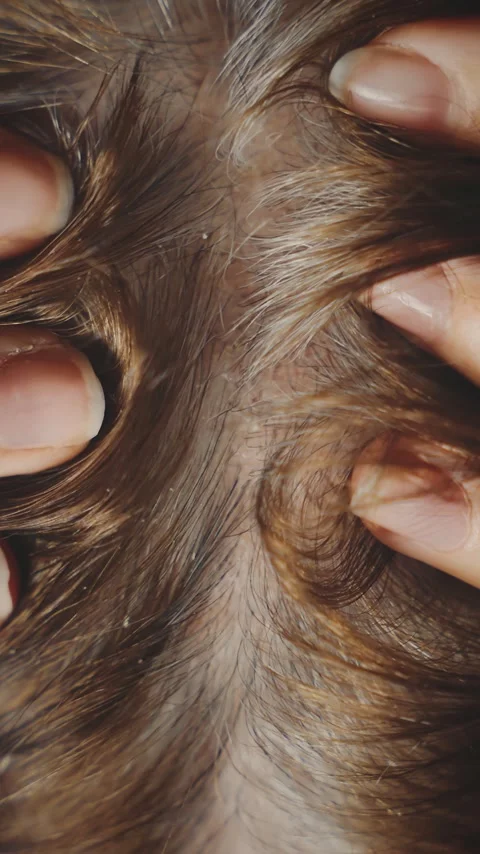 Human head close up grown gray hair roots brunette dyed color. person aging gray Stock Footage 342243011