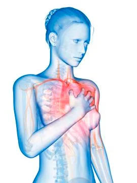 Human heart attack, illustration Stock Illustration
