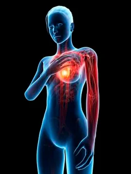 Human heart attack, illustration Stock Illustration