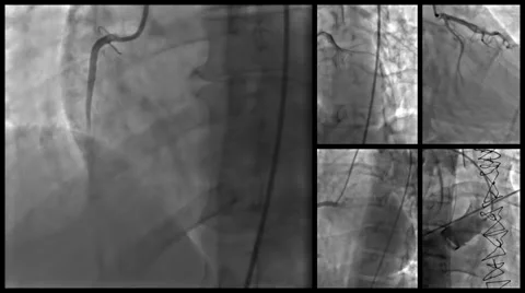 Human Heart Catheterization Scans Stock Footage