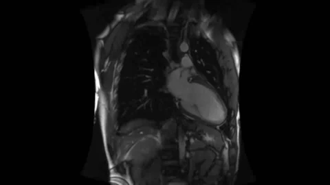 Human heart mri in real time, heartbeat, frontal Видео 140903239