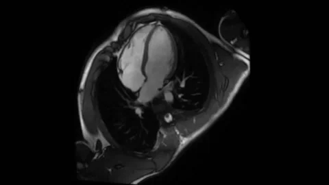 Human heart mri in real time, heartbeat Stockbeeldmateriaal 140903253