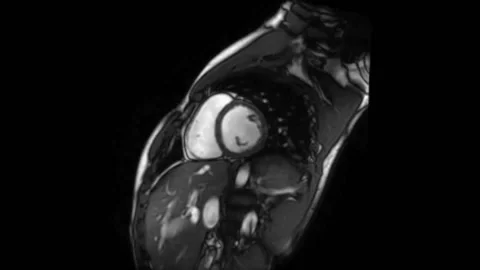 Human heart mri in real time, heartbeat, frontal Stockbeeldmateriaal 140903258