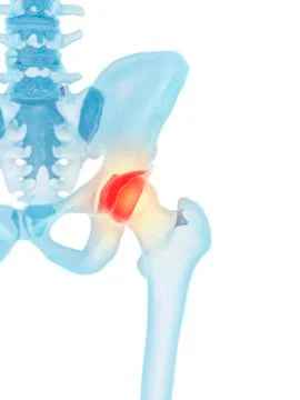Human hip joint, artwork Stock Illustration