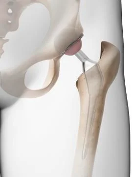 Human hip replacement, artwork Stock Illustration