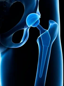 Human hip replacement, artwork Stock Illustration