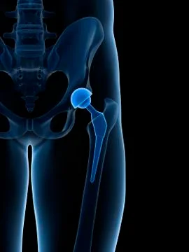 Human hip replacement, artwork Stock Illustration