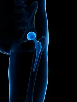 Human hip replacement, artwork Stock Illustration