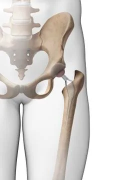 Human hip replacement, artwork Stock Illustration
