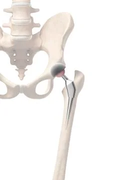 Human hip replacement, artwork Stock Illustration