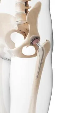 Human hip replacement, artwork Stock Illustration