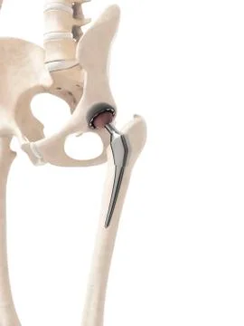 Human hip replacement, artwork Stock Illustration