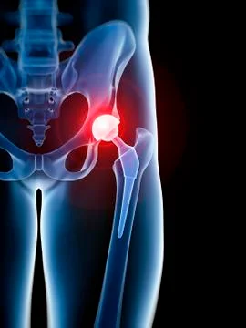 Human hip replacement, illustration Stock Illustration