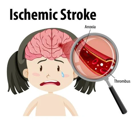 Human with Ischemic stroke Stock Illustration