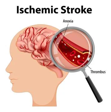 Human with Ischemic stroke Stock Illustration
