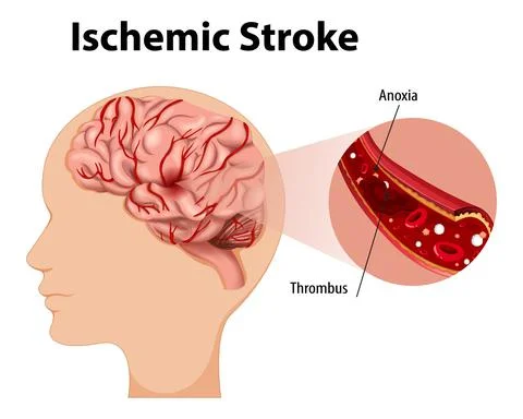 Human with Ischemic stroke Stock Illustration