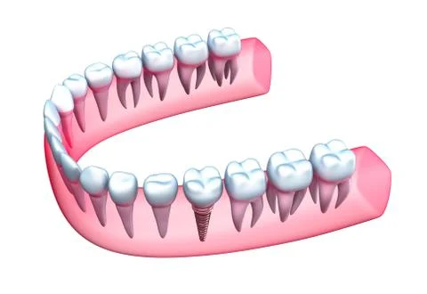 Human jaw model with teeth and implant. Stock Illustration