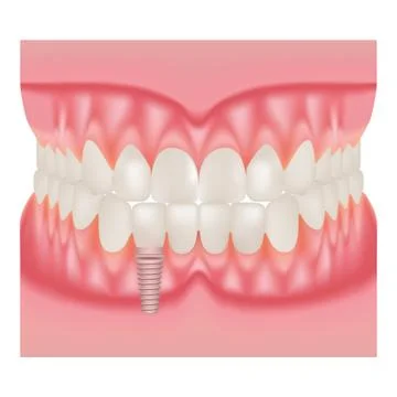 Human Jaw Model With Teeth And Implant. Installation Of Dental Implants Isolated Stock Illustration