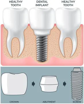 Human jaw with normal healthy teeth and prosthesis in gum above structure of Stock Illustration