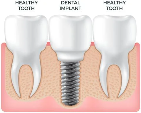 Human jaw with normal teeth and dental implant. Treatment, dentistry, health Stock Illustration