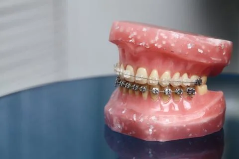 Human jaw or teeth model with metal wired dental braces Stock Photos