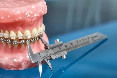 Human jaw or teeth model with metal wired dental braces Foto stock