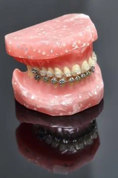 Human jaw or teeth model with metal wired dental braces Stock Photos