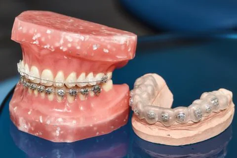 Human jaw or teeth model with metal wired dental braces Stock Photos