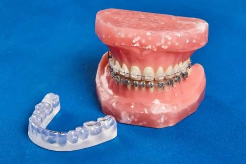Human jaw or teeth model with metal wired dental braces Stock Photos