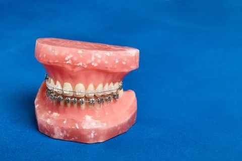 Human jaw or teeth model with metal wired dental braces Foto stock