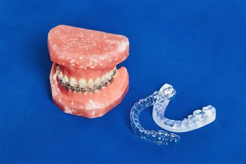 Human jaw or teeth model with metal wired dental braces Foto stock