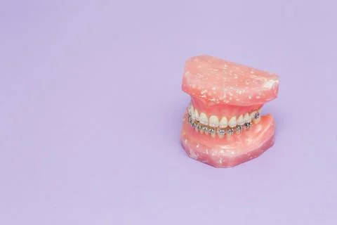 Human jaw or teeth model with metal wired dental braces Stock Photos