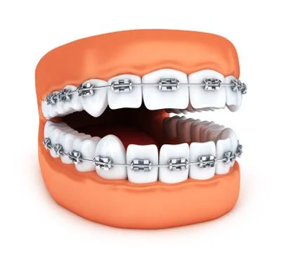 Human jaw tooth and brackets. 3d illustration Stock Illustration